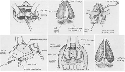 [pdf] Sublabial Rhinoseptoplastic Technique For Transsphenoidal