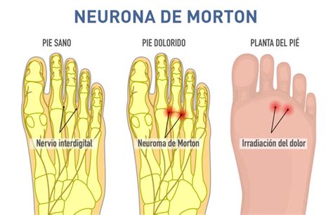 Neurona de Morton Policlínico San Miguel