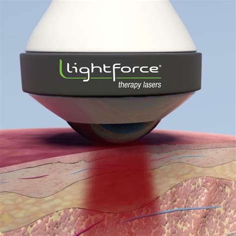 Laser Therapy Medical Treatment Class IV | LightForce Therapy Lasers