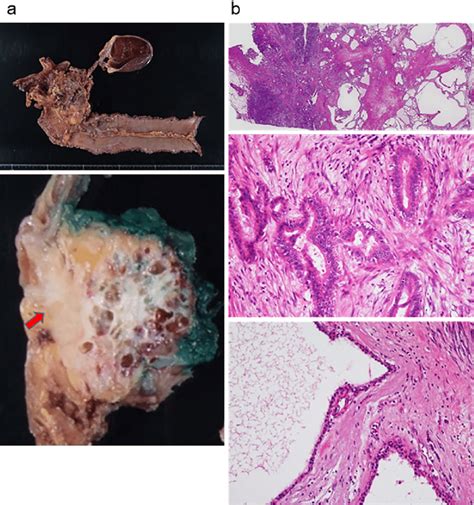 Figure Pathological Images Of The Resected Specimen A Grossly The