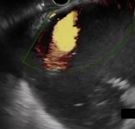 Large Caliber Metal Stent Controls Significant Entry Site Bleeding