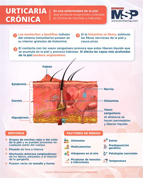 Urticaria Crónica