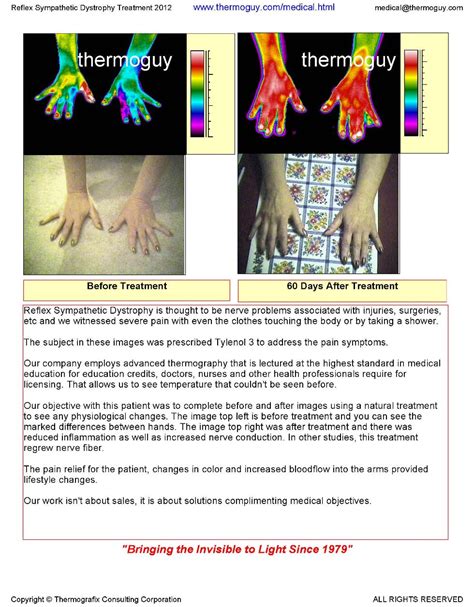 Reflex Sympathetic Dystrophy