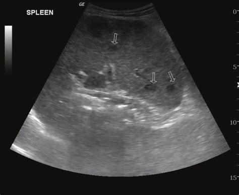 Usg Of Abdomen Showed Changes Suggestive Of Multiple Granulomas In The