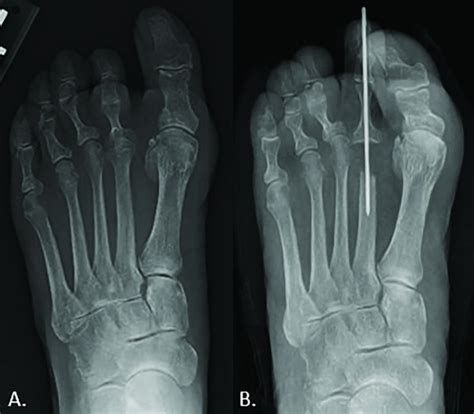 Metatarsal Head View