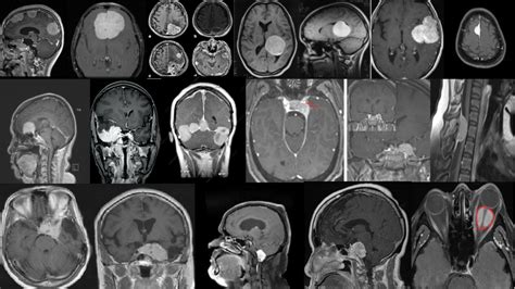 Meningiomas O que são Sintomas e Tratamento Dr Irlon Oliveira