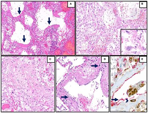 Frontiers Long Term Persisting SARS CoV 2 RNA And Pathological