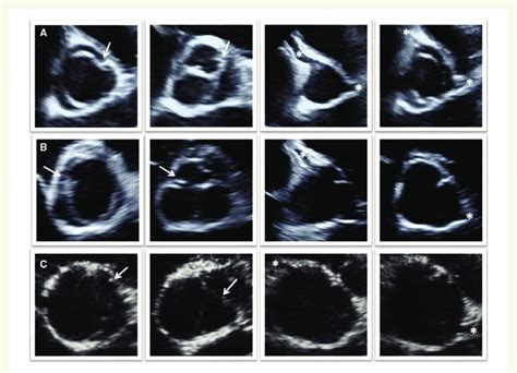 Bicuspid Aortic Valve Echo