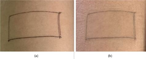 Appearance of irritation test results on the forearm: (a) before; and ...