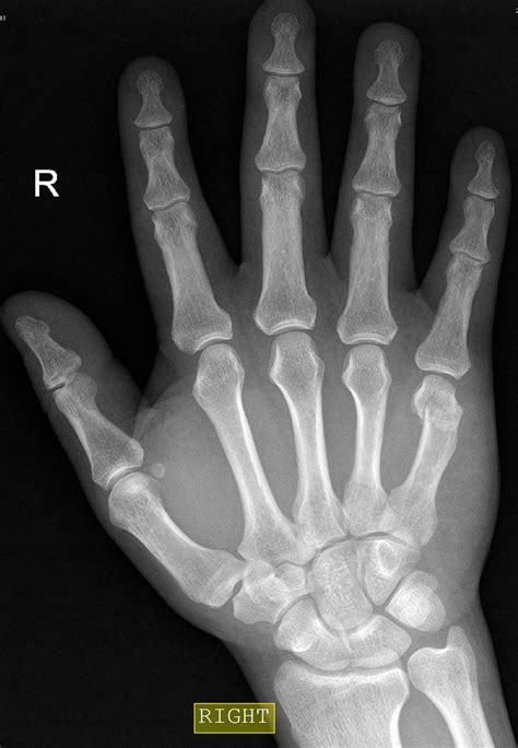 What Does Boxer's Fracture Look Like at Clinton Spears blog