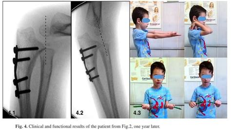 Pediatric Radial Head Dislocation Ppt