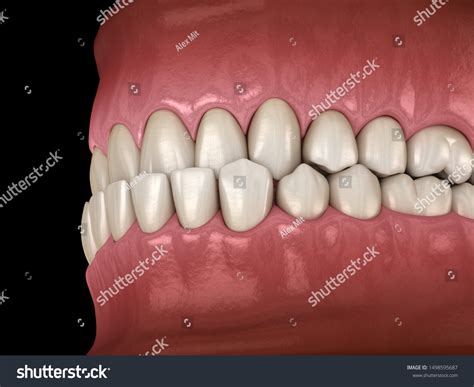 Underbite Dental Occlusion Malocclusion Teeth Medically Stock