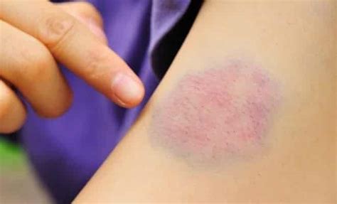 Roxo Verde Amarelo Por Que O Hematoma Muda De Cor 24 05 2019