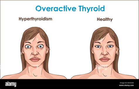 Face Of An Adult Female Exhibiting The Symptoms Of Hyperthyroidism Stock Vector Art