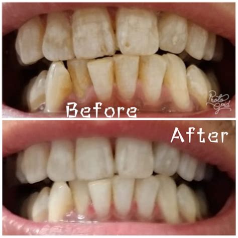 List 93 Pictures Teeth Whitening Before And After Full Face Superb