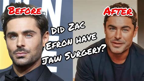 Zac Efron Before And After Broken Jaw And Surgery Nip Talk Ep 8