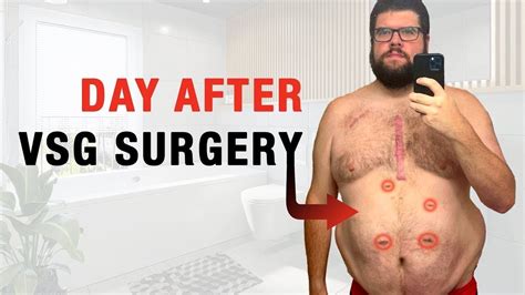 Day After Vsg Surgery What To Expect Youtube