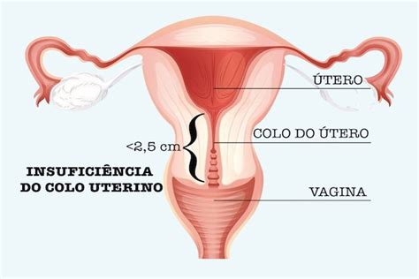 O Que Insufici Ncia Do Colo Uterino Tua Sa De