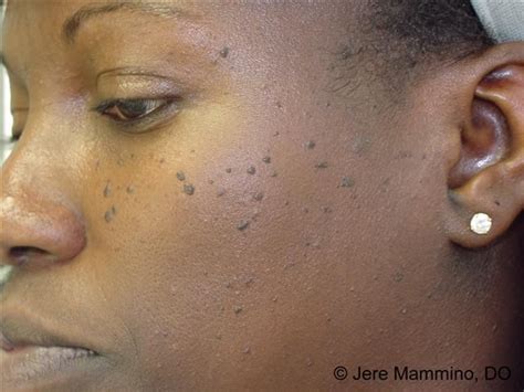 16 Types Of Bumps And How To Get Rid Of Them Leurr