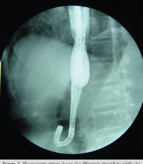 Pdf Pneumatic Dilatation Of Achalasia In A Patient With Sigmoid