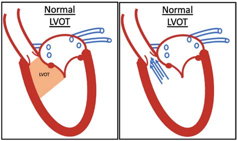 Left Ventricular Outflow Tract Obstruction Lvoto And Sam