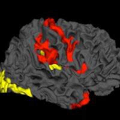 MRI reveals how schizophrenia may improve | AuntMinnieEurope