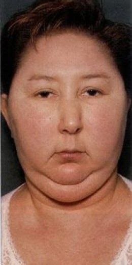 Moon Face Cushing Syndrome Moon Face Cushings Disease - SUINDACHO