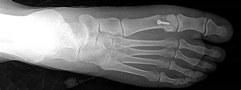 FDFAC San Francisco Sports Medicine - Sesamoid Injuries - Turf Toe ...