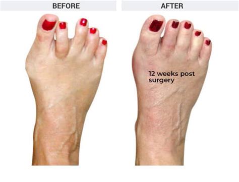 Minimally Invasive Bunion Surgery Bunionplasty The Bunion Institute