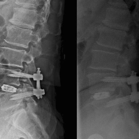 Lateral Decubitus Single Position Anterior Posterior Ap Fusion Shows Equivalent Results To