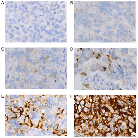 Positive PDL1 Expression Is Predictive For Patients With Advanced EGFR