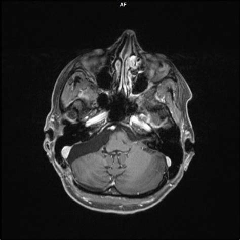 The T1 Weighted Contrast Enhanced MR Image Taken After The Surgery