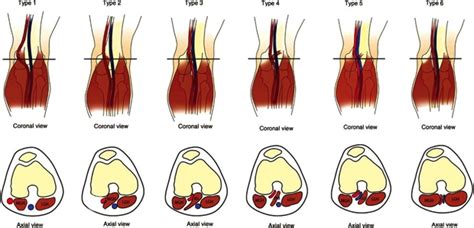 Sports Injury Bulletin - Anatomy - Popliteal artery entrapment: a mysterious syndrome