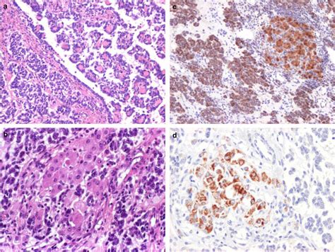 Uterine Tumors Resembling Ovarian Sex Cord Tumors Are Polyphenotypic