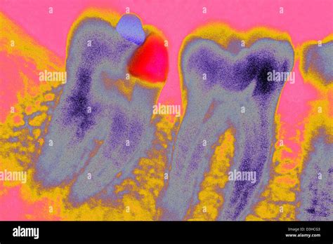 Tooth Decay X Ray Hi Res Stock Photography And Images Alamy