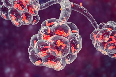 Klebsiella Pneumoniae Neden Oldu U Hastal Klar Soruyeri Ile Arad N