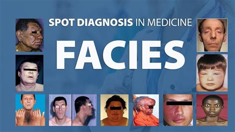 Abnormal Facies Spot Diagnoses In Medicine Youtube