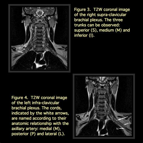 MRI BLOG: Brachial Plexus MRI (I/II)