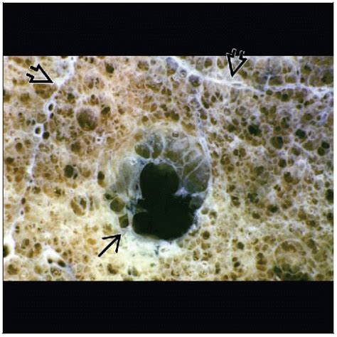 Emphysema, Centrilobular | Radiology Key