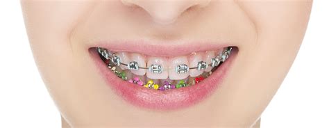 Brackets de colores Los divertidos Solución Dental