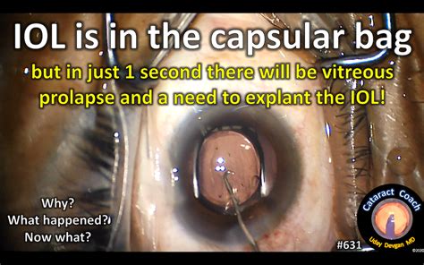 From Routine Case To Disaster In 1 Second Cataract Coach™