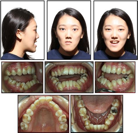 Pretreatment Facial And Intraoral Photographs Download Scientific