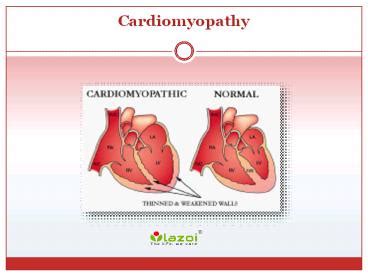 Ppt Cardiomyopathy Causes Symptoms Types Diagnosis And Treatment