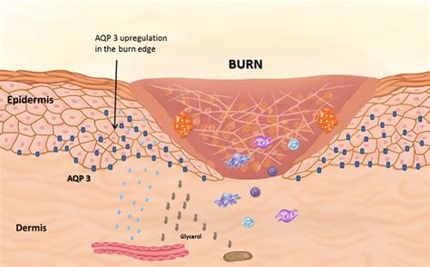 Figure From Epidermal Aquaporin Is Increased In The Cutaneous Burn