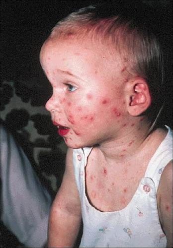 Varicella Chickenpox And Shingles Flashcards Quizlet