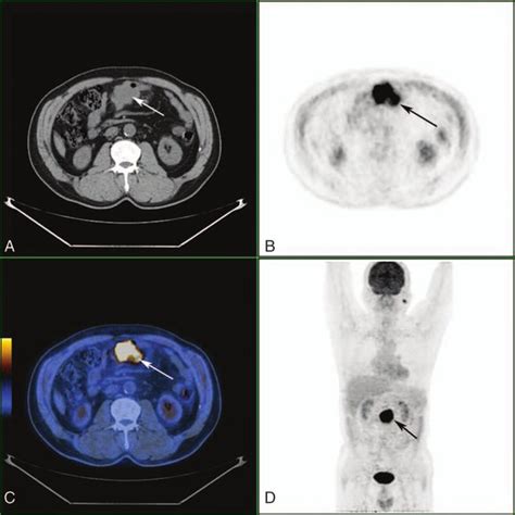 Positron Emission Tomography Computed Tomography Pet Ct Indicated