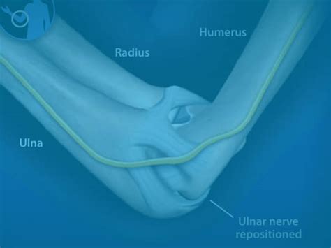 Ulnar Nerve Surgery at the #1 Ranked Orthopaedic Hospital in Nebraska