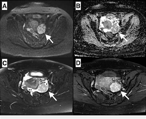 Figure 1 From A Rare Triplet Found In A Patient With Drug Resistant