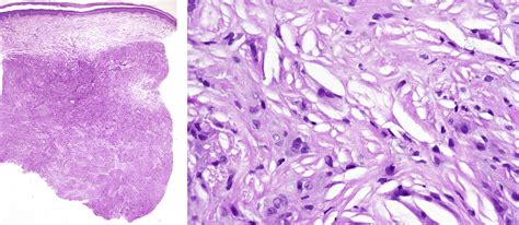 Cerebrotendinous Xanthomatosis A Report Of 3 Cases Jaad Case Reports