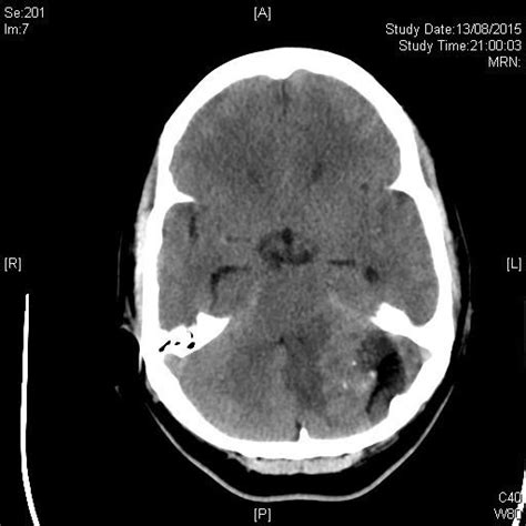 Intracranial Dermoid Cyst Pacs